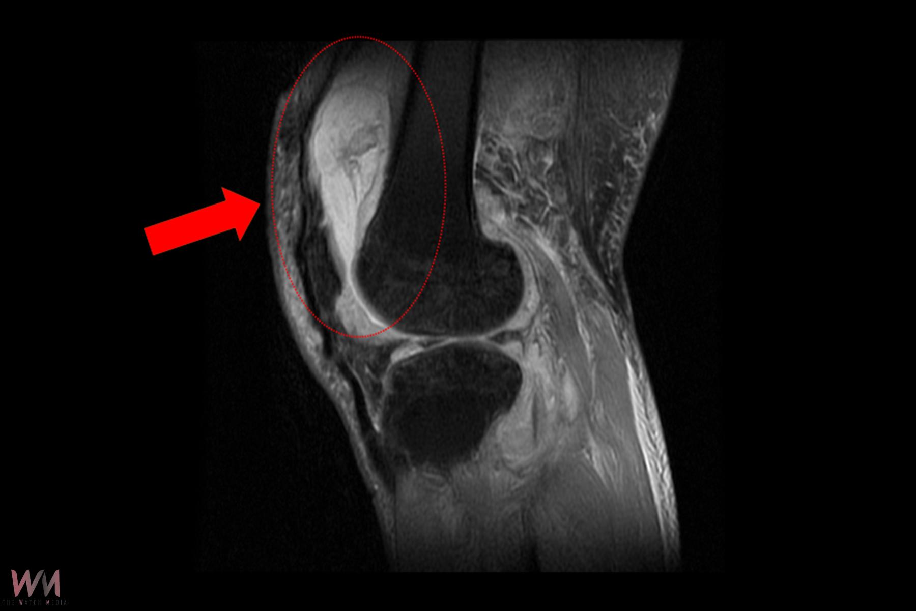 結核菌侵襲膝蓋腫痛難熬　台中慈濟醫院團隊救膝關節　　 - https://www.watchmedia01.com